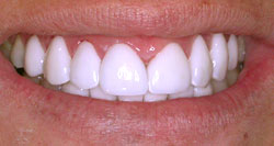 APRÈS - Exemple de cas de dentisterie esthétique