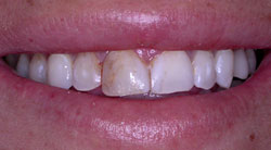 AVANT - Exemple de cas de dentisterie esthétique
